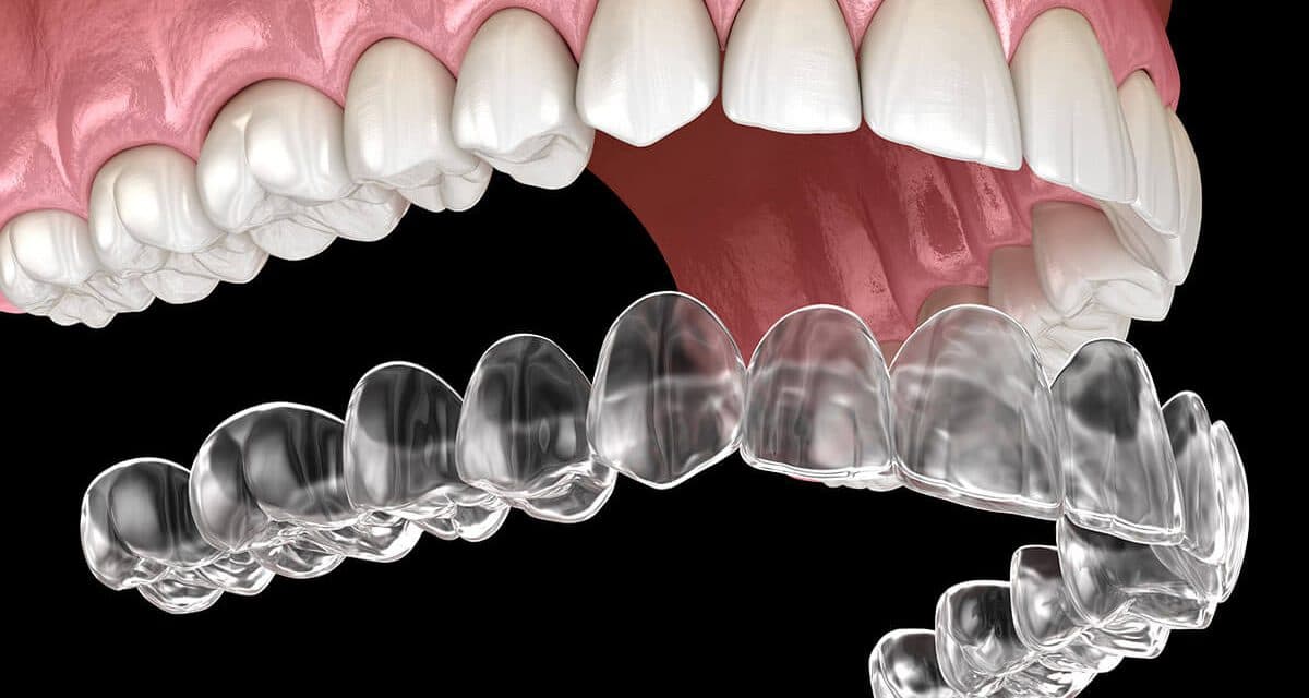 Benefits of Clear Aligners at Avana Dental