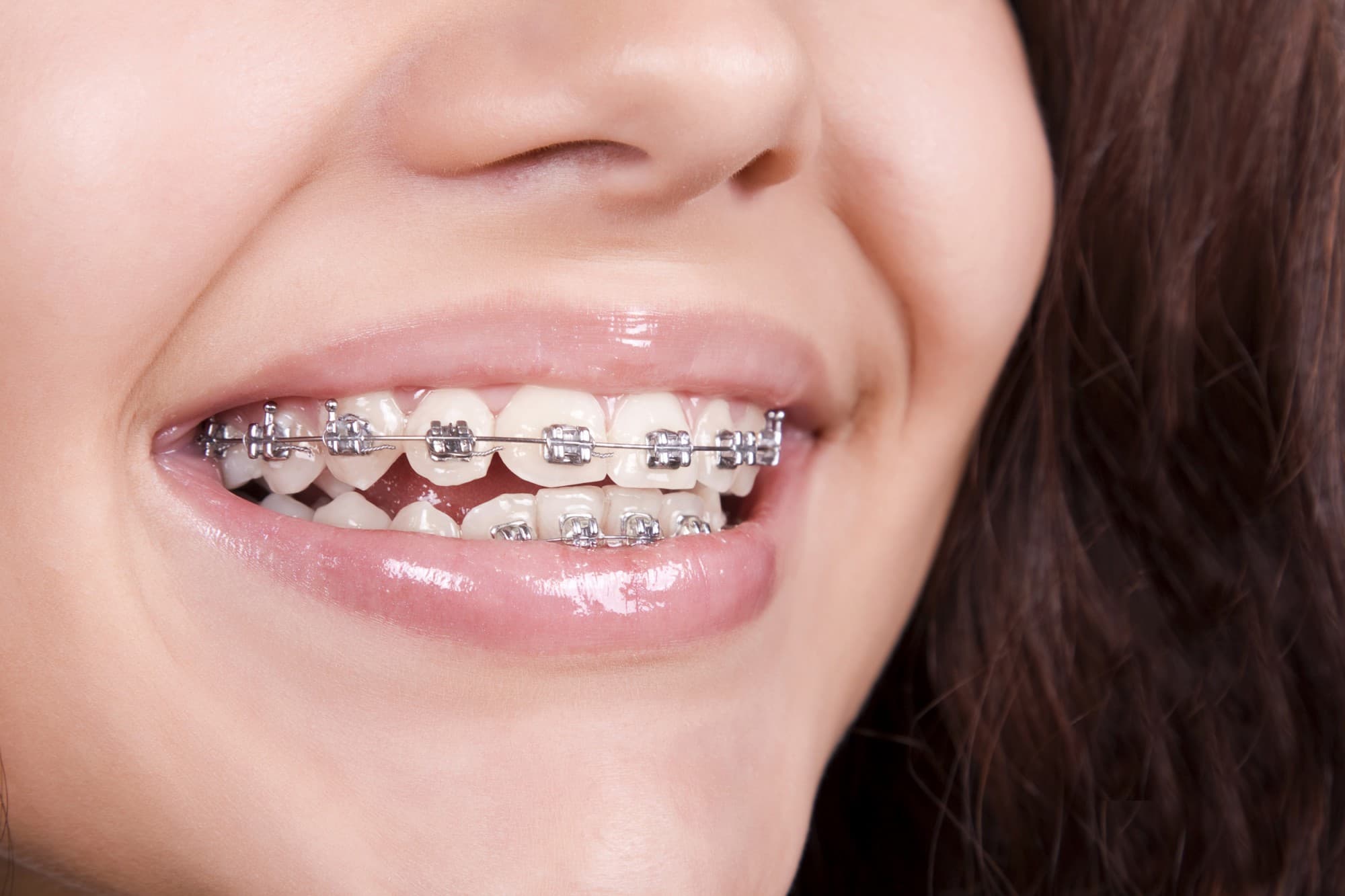 Benefits of Teeth Braces Treatment at Avana Dental