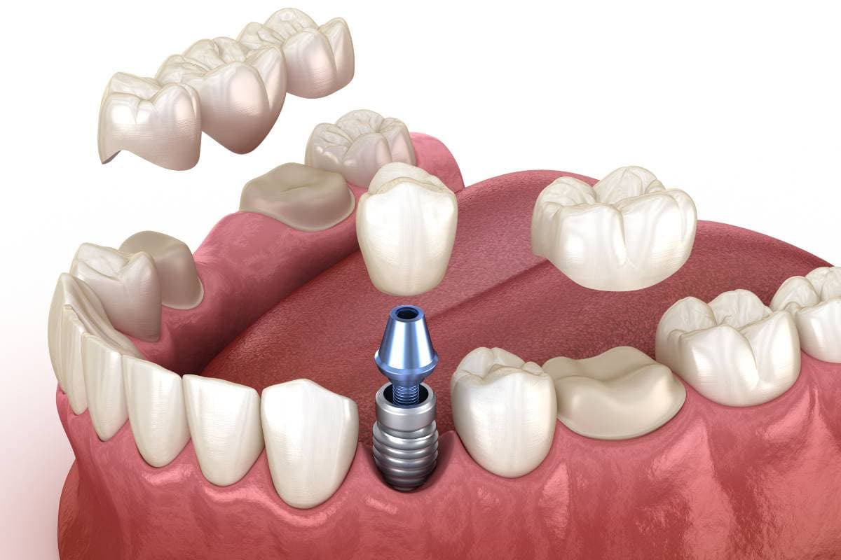 What Are Dental Crowns and Bridges