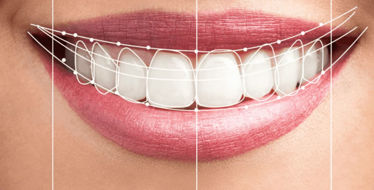 Smile Designing Treatment at Avana Dental