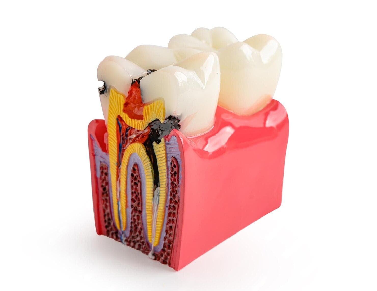 Benefits of Root Canal Treatment at Avana Dental