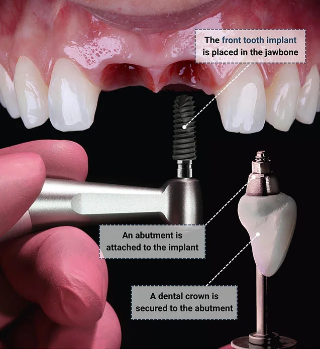 Dental Implants in Gomti Nagar, Lucknow: Your Complete Guide to a Perfect Smile